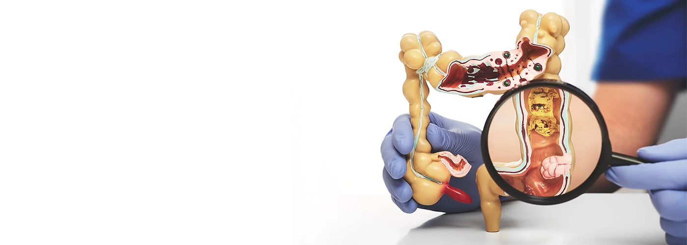 How to Diagnose Colorectal Cancer