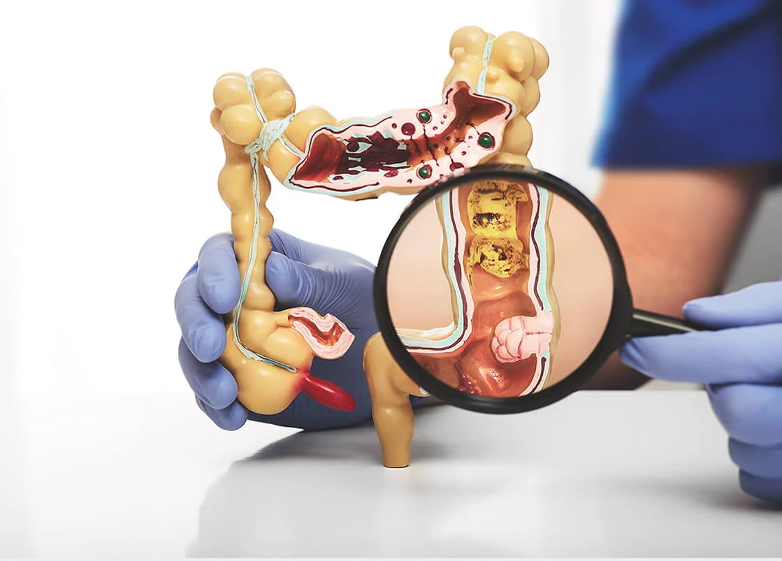 how-colorectal-cancer-is-diagnosed